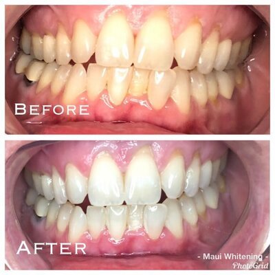 Teeth Whitening Before and After 1