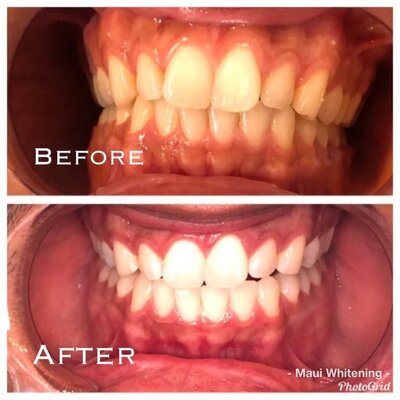 Teeth Whitening Before and After 2