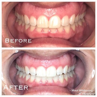 Teeth Whitening Before and After 3